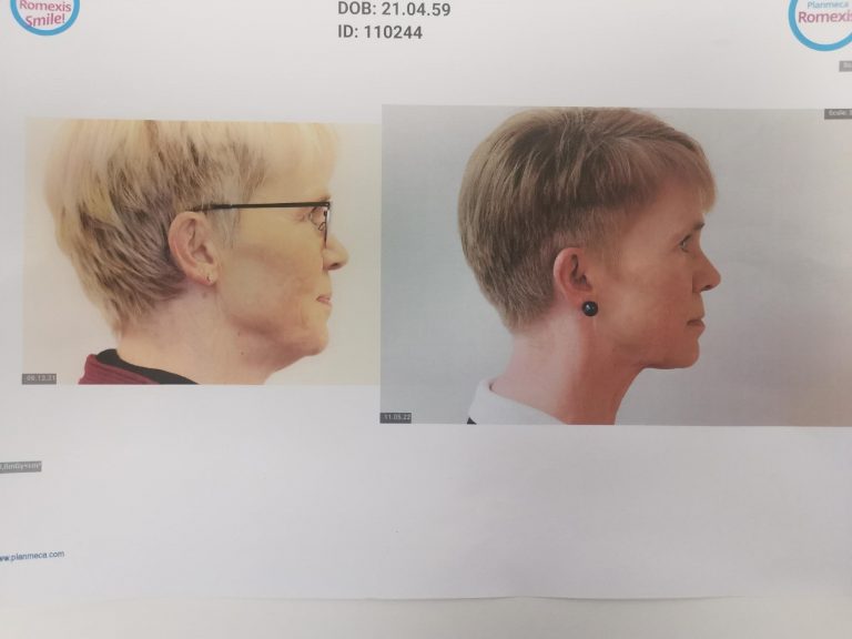 SleepClinic TRP (Tongue Right Positioner)